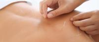 A patient receiving acupuncture treatment